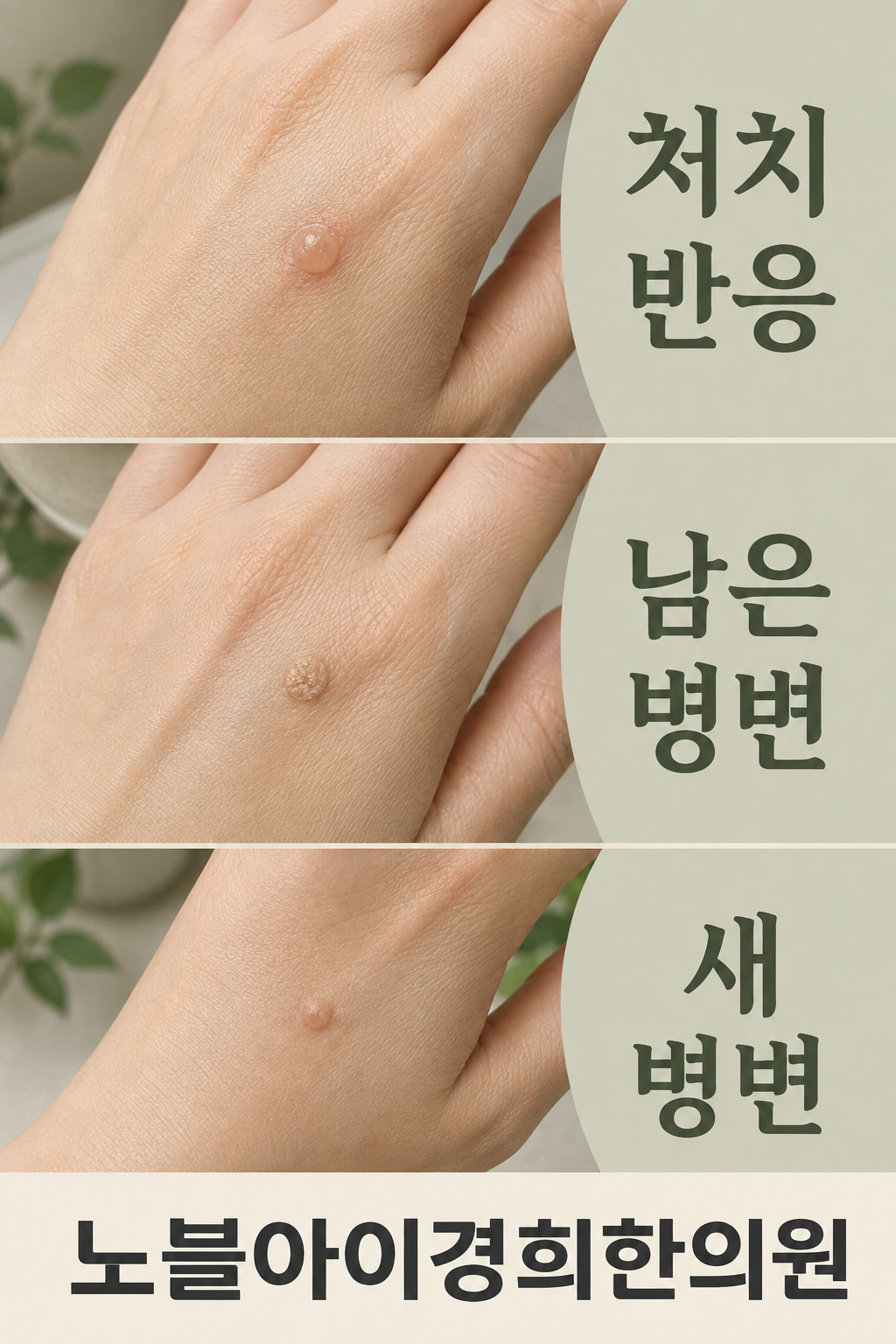 사마귀 치료 뒤 처치 반응과 남은 병변 및 다른 위치의 새 병변을 구분한 그림